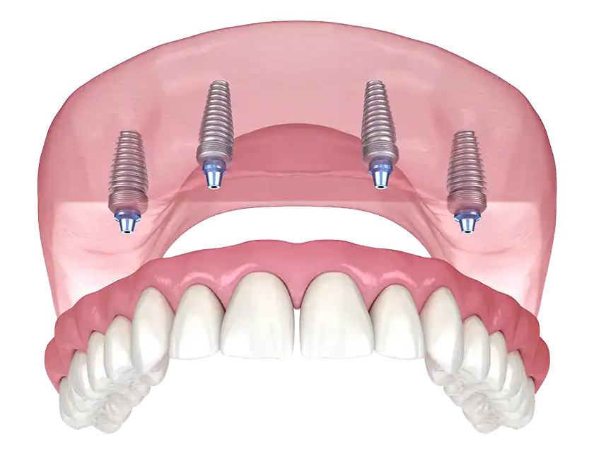 FAQs About All-on-4 Dental Implants: Your Complete Guide