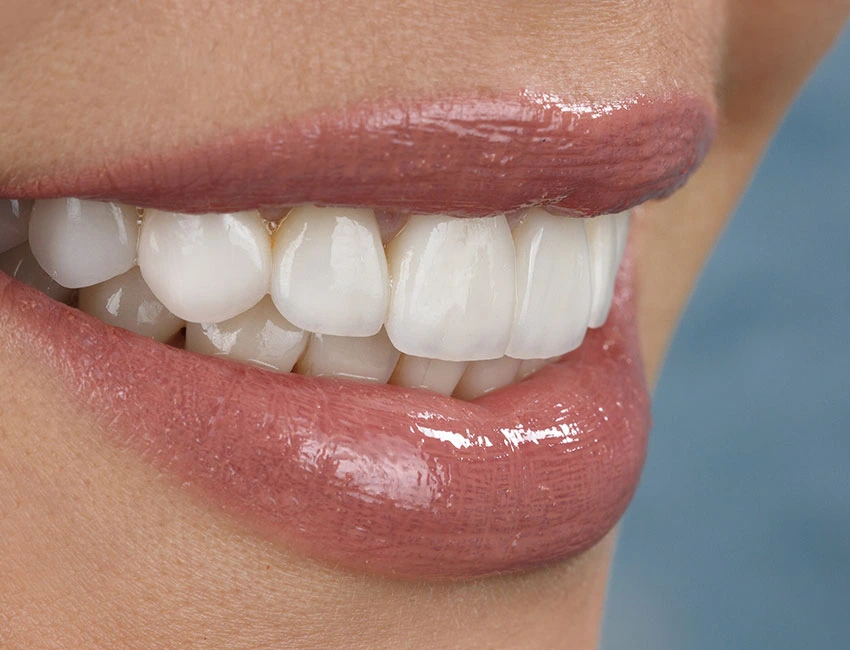 I Want Veneers: Where Do I Start?