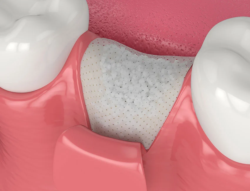 What To Expect During a Teeth Removal: A Guide to a Smooth Recovery