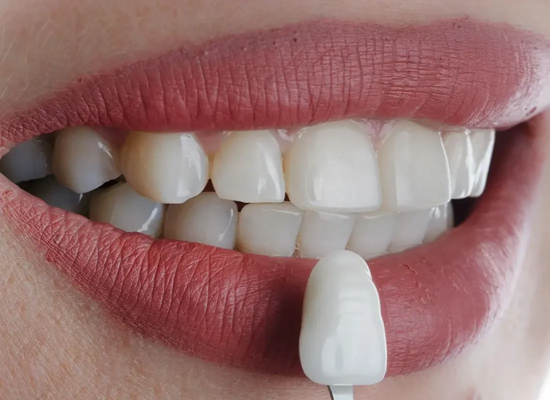 How Digital Smile Design Creates Perfect Results