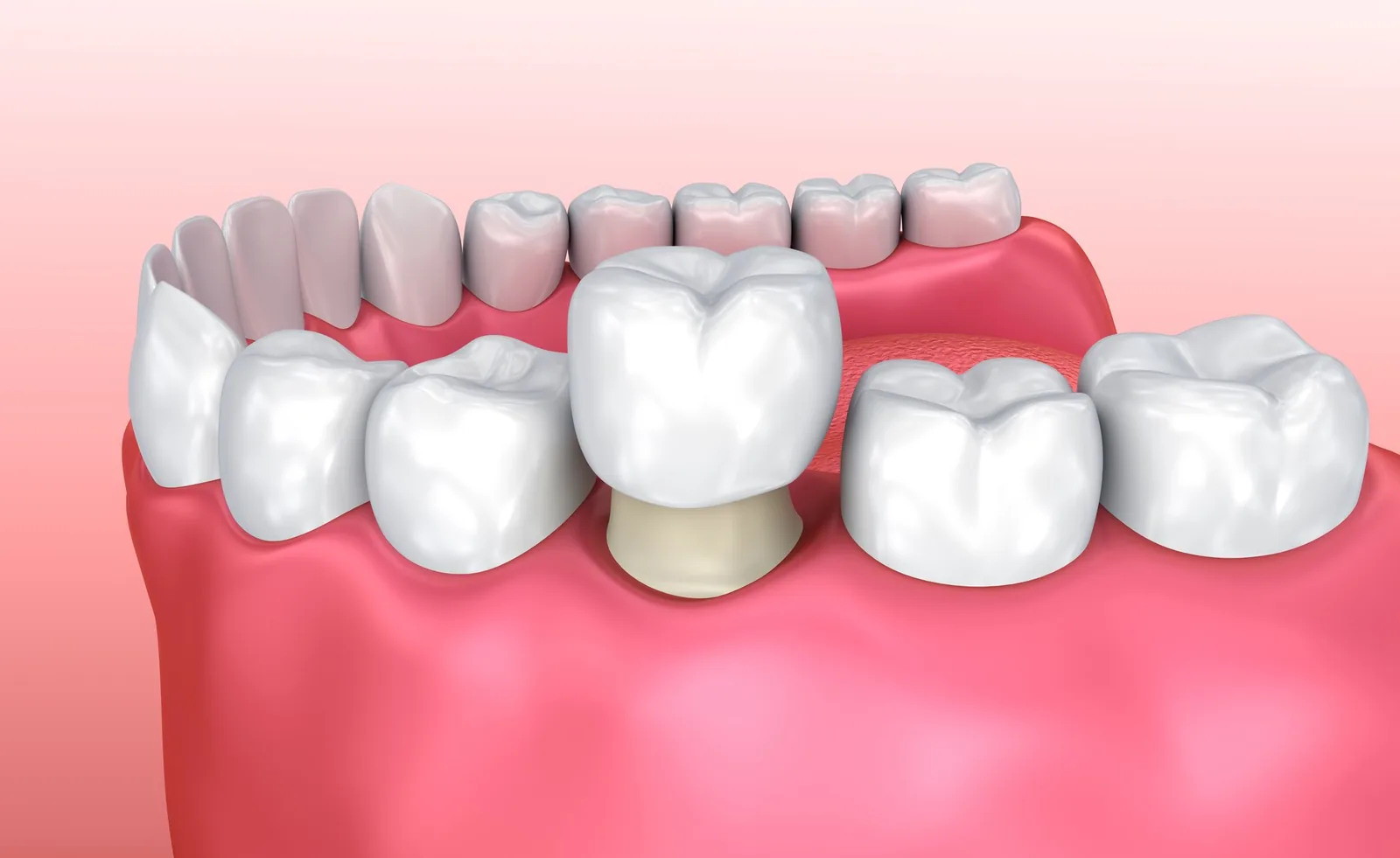Can You Get a Crown in One Visit? What to Expect With Same-Day Crowns