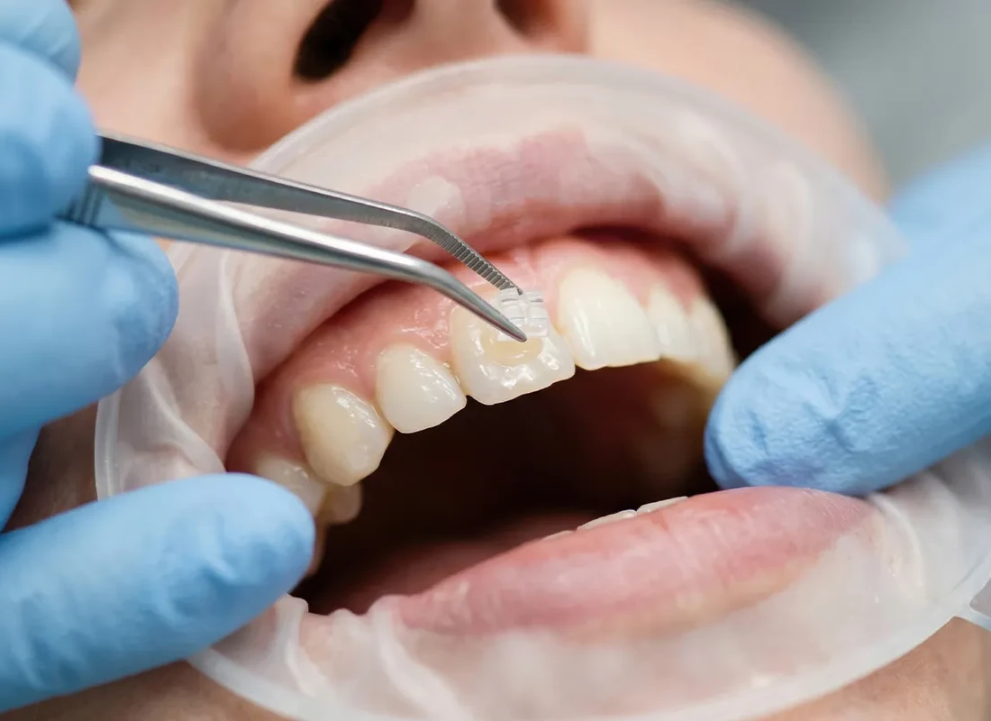 Tooth Bonding in Oxnard, CA