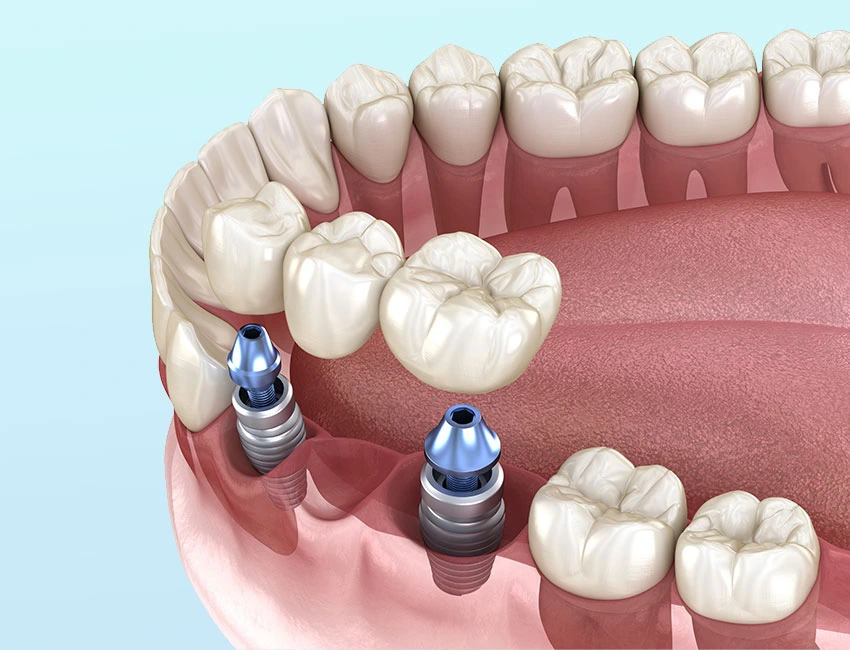 Implants vs. Traditional Dentures: Making the Right Choice