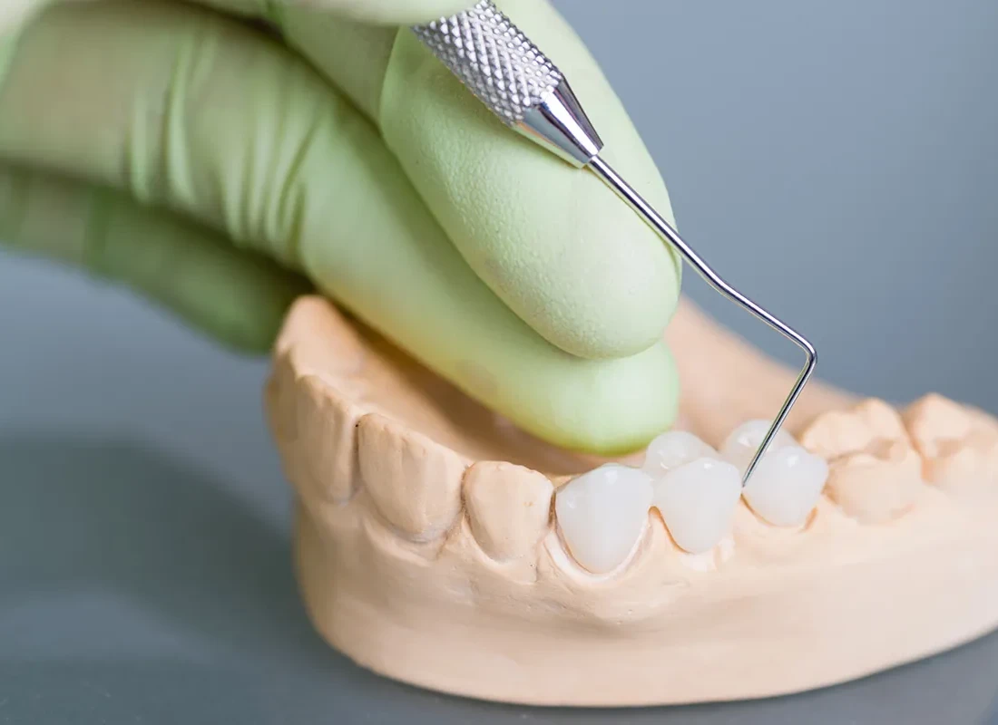 What is Dental Bridges