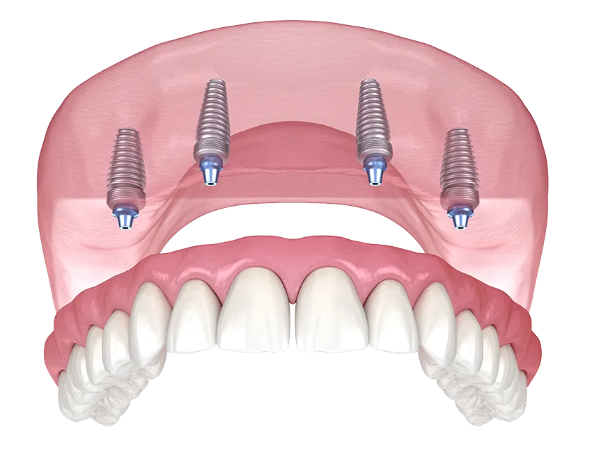 All-on-4 Dental Implants illustration