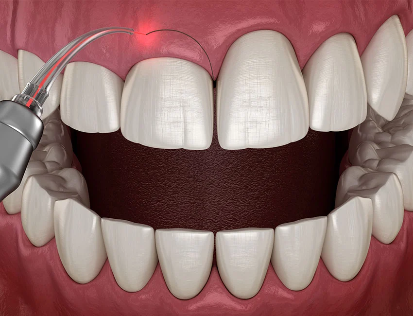 What is Esthetic Gum Recontouring