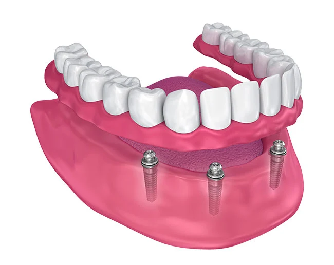 What is Implant Overdentures