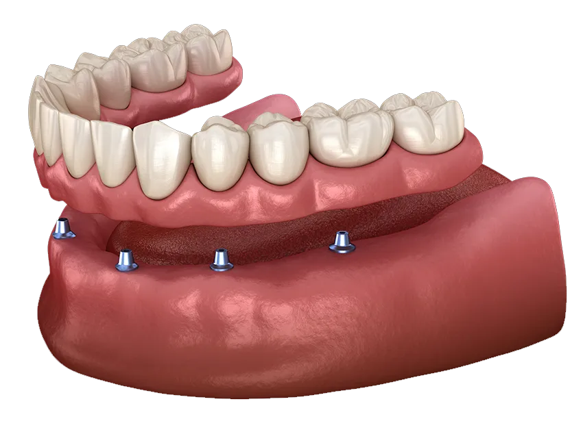 Implant Overdentures illustration