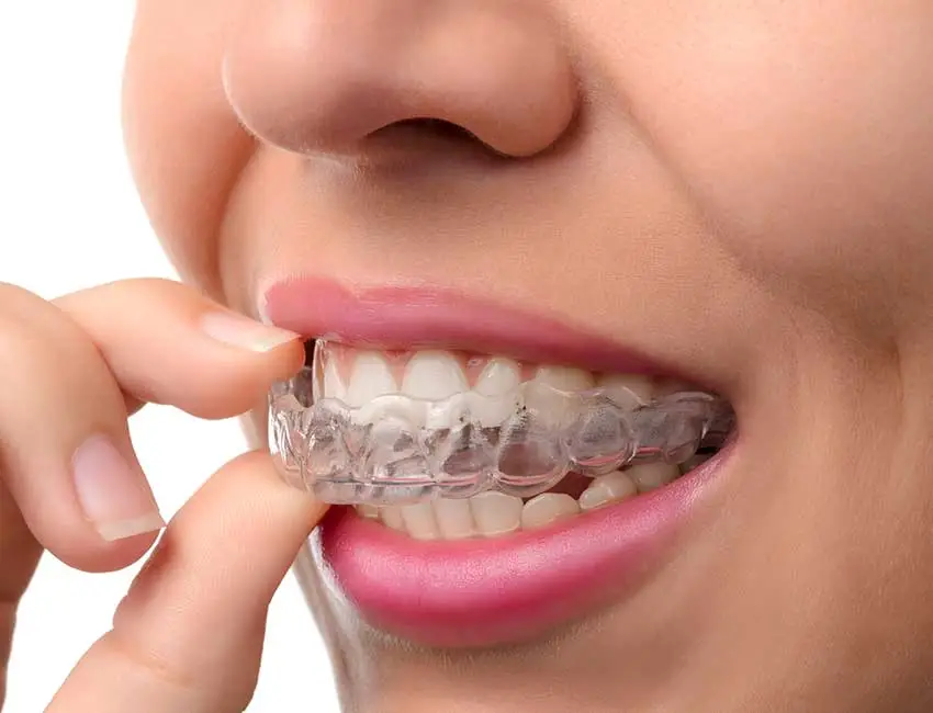 Mouthguards in Oxnard, CA