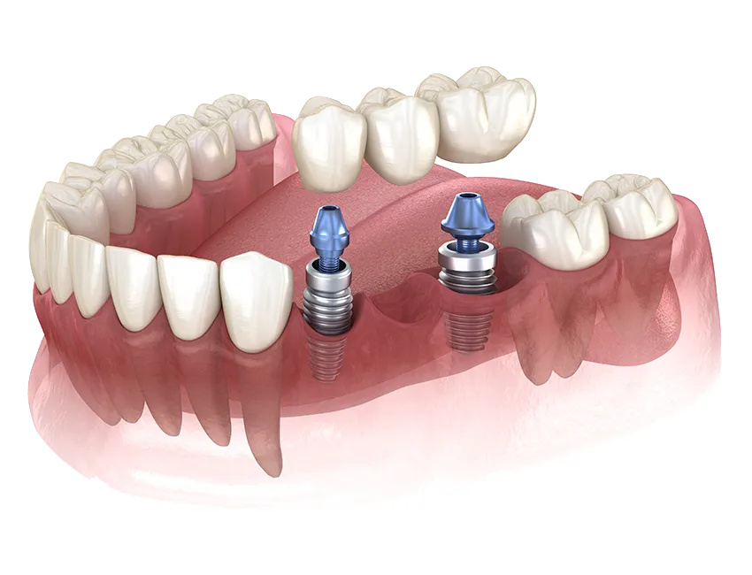 Implant-Supported Bridge illustration