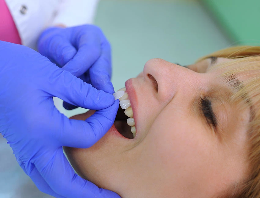 Veneers in Oxnard, CA
