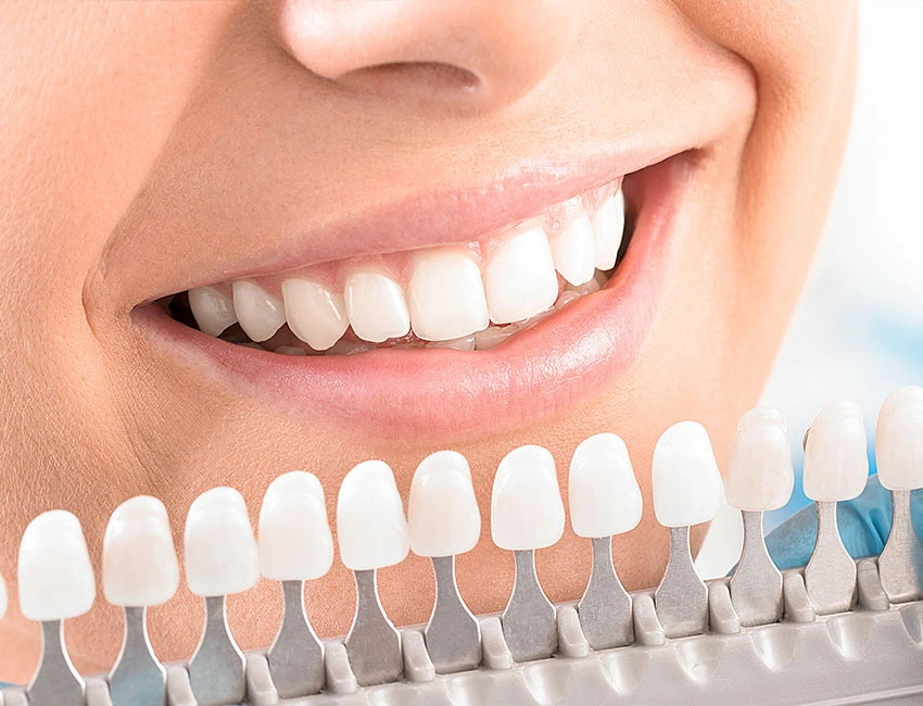 Teeth whitening