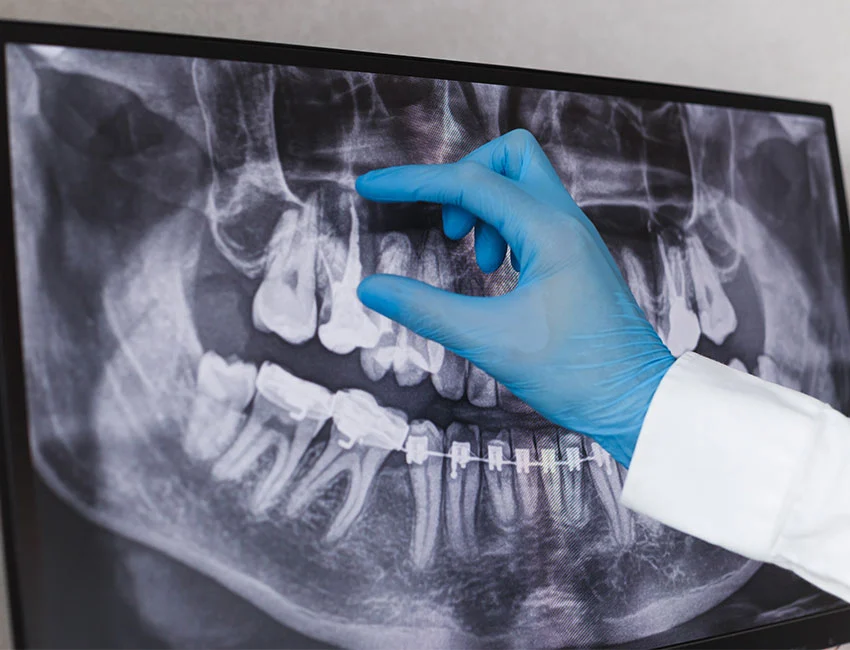 What is Root Canal Therapy