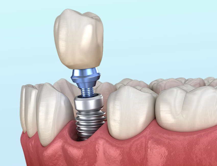 replace a missing tooth