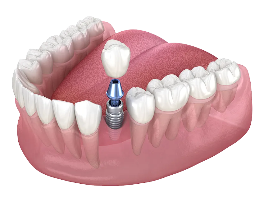 Single Tooth Implant illustration