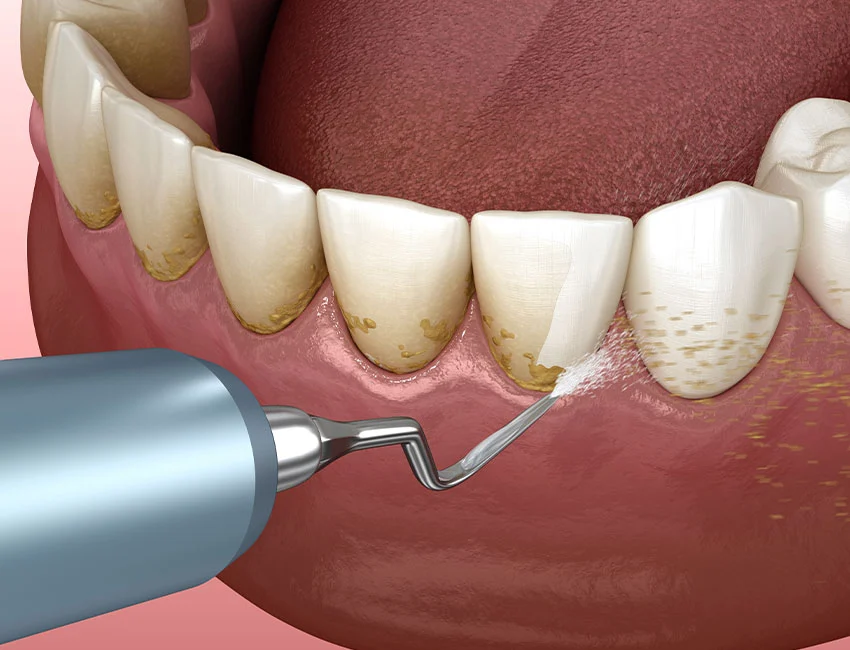 What is Dental Hygiene