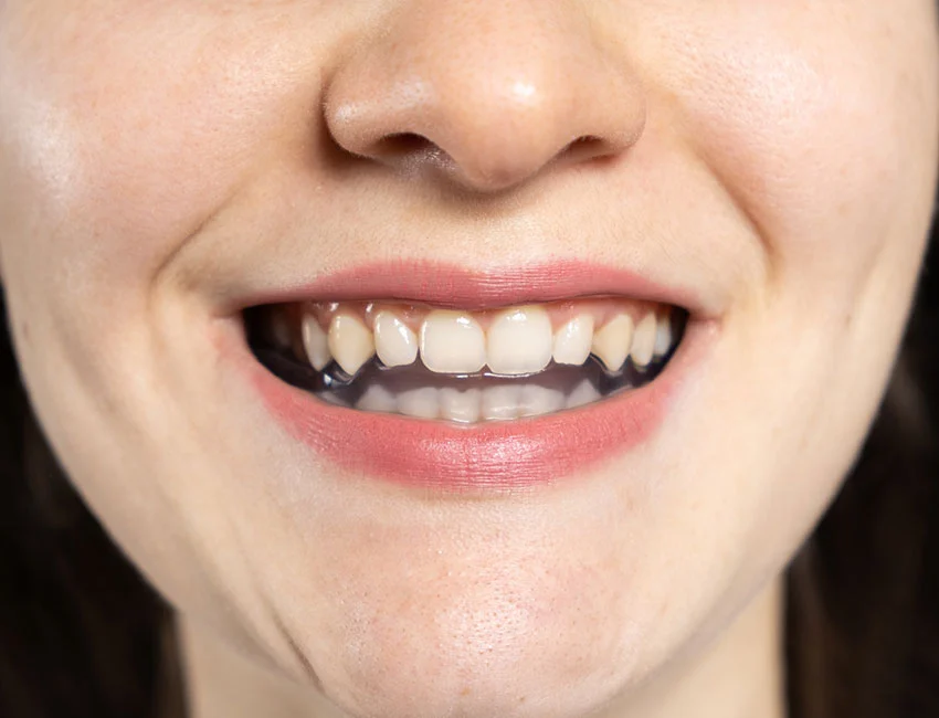 TMJ and Bruxism Treatment at Seren Advanced Dentistry Oxnard