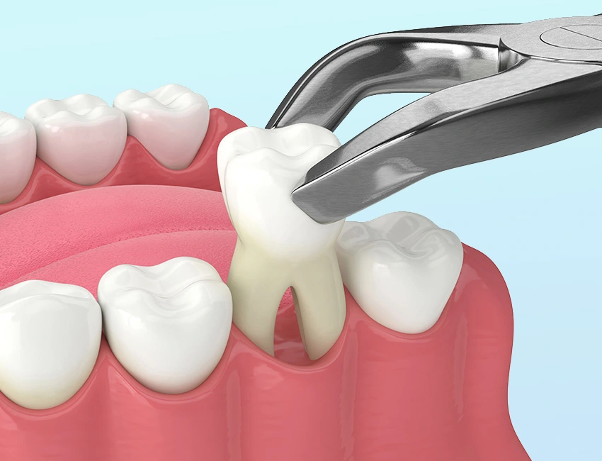 Why Is Dental Extraction Sometimes Necessary?