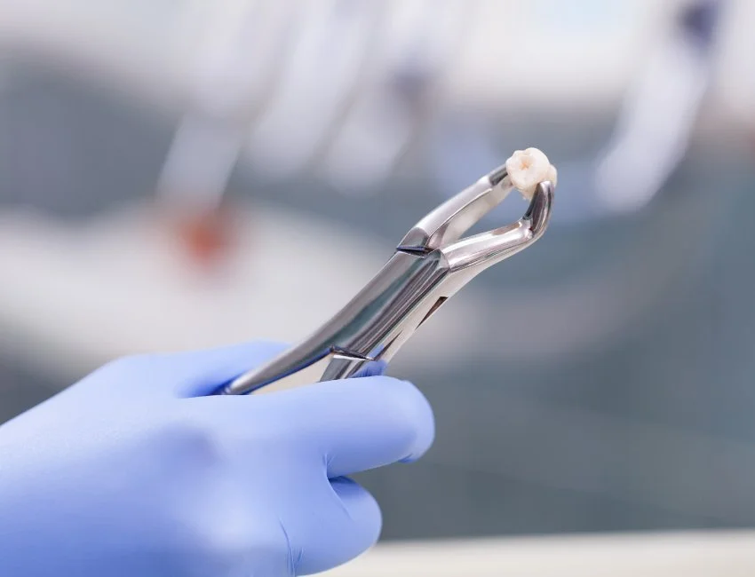 Tooth Extraction in Oxnard, CA